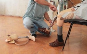 amputation-injury-prosthetic-leg